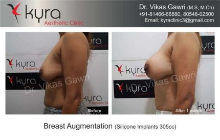 Breast Augmentation