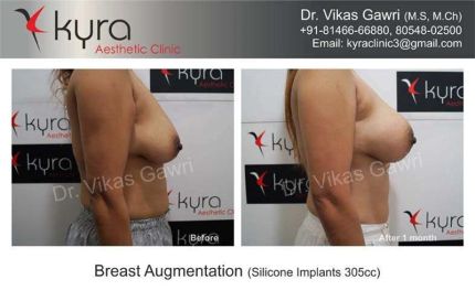 Breast Augmentation