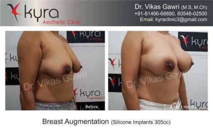 Breast Augmentation