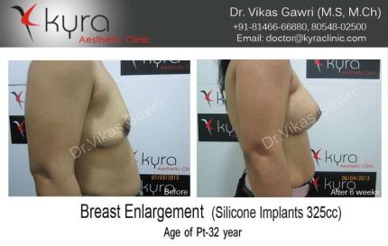 Breast Enlargement Silicone Implants