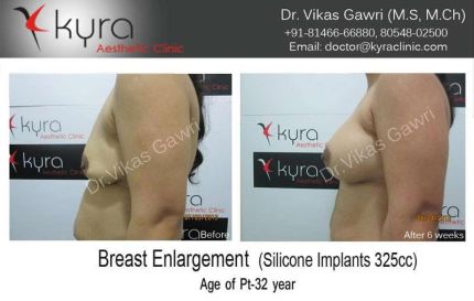 Breast Enlargement Silicone Implants