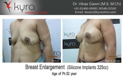 Breast Enlargement Silicone Implants