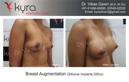 Breast Enlargement Silicone Implants