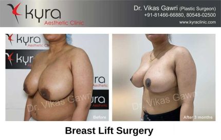 Breast-Lift-Surgery