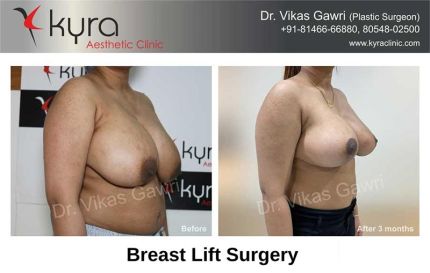 Breast Lift Surgery