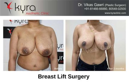 Breast Lift Surgery