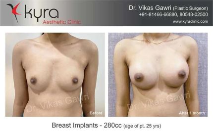 Breast Lift surgery