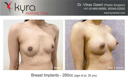 Breast Lift surgery