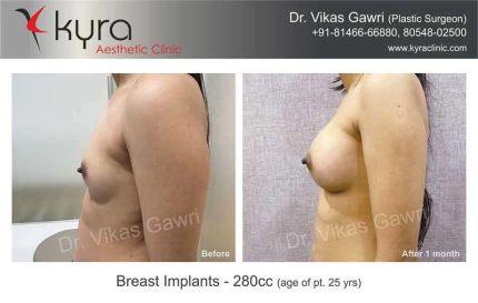 Breast Lift surgery