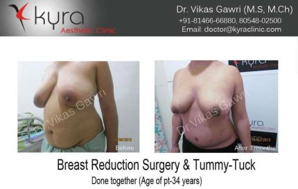 Breast Lift surgery