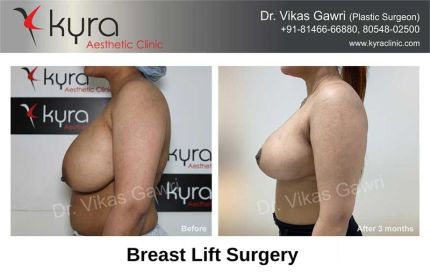 Breast Lift surgery