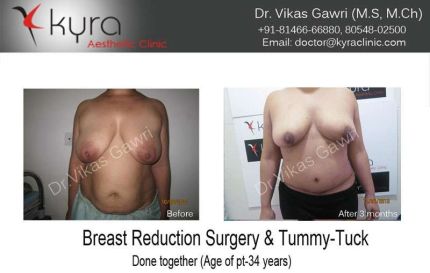 Breast Reduction Surgery Tummy Tuck