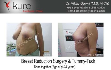 Breast Reduction Surgery Tummy Tuck