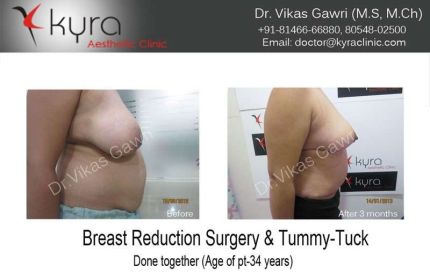 Breast Reduction Surgery Tummy Tuck