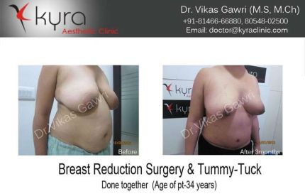 Breast Reduction Surgery Tummy Tuck