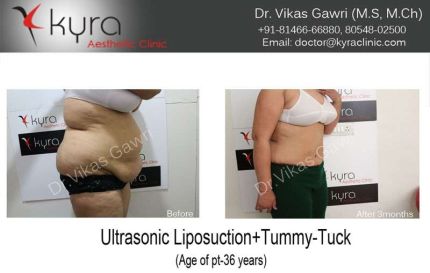 Breast Reduction Surgery Tummy Tuck