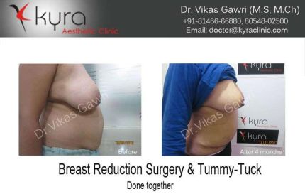 Breast Reduction Surgery Tummy Tuck