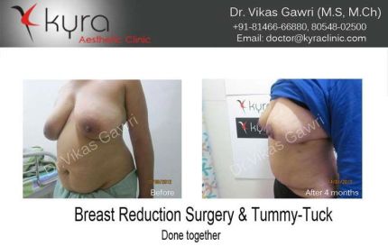 Breast Reduction Surgery and Tummy Tuck