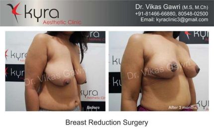 Breast Reduction Surgery