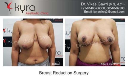 Breast Reduction Surgery