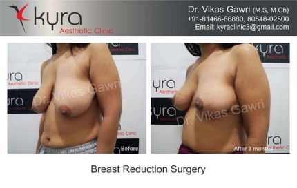 Breast Reduction Surgery