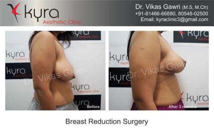 Breast Reduction Surgery