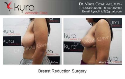 Breast Reduction Surgery