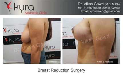 Breast Reduction Surgery