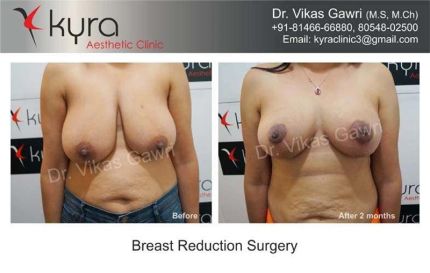 Breast Reduction Surgery