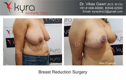 Breast Reduction Surgery