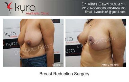 Breast Reduction Surgery