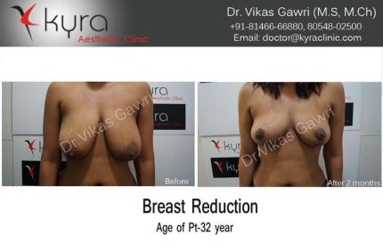 Breast Reduction Surgery