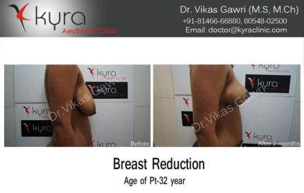 Breast Reduction Surgery