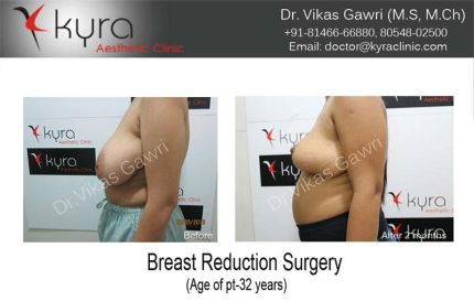 Breast Reduction Surgery