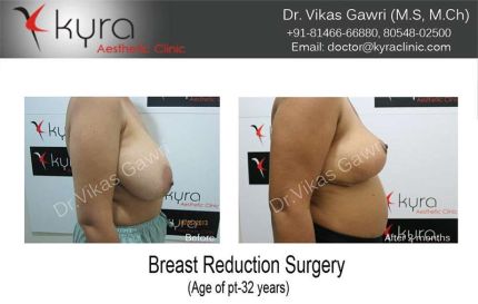 Breast Reduction Surgery