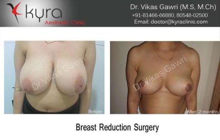 Breast Reduction Surgery