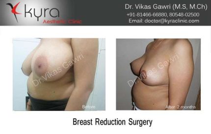 Breast Reduction Surgery