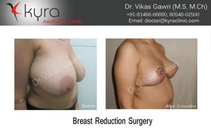 Breast Reduction Surgery