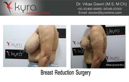 Breast Reduction Surgery