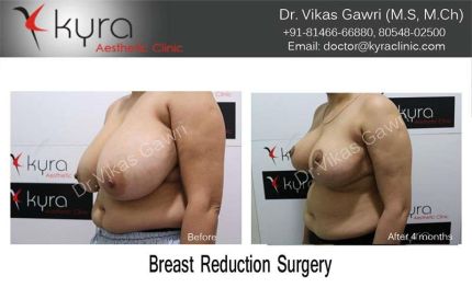 Breast Reduction Surgery