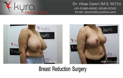 Breast Reduction Surgery