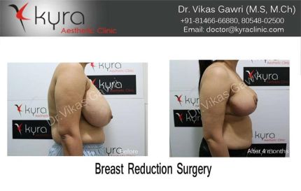 Breast Reduction Surgery