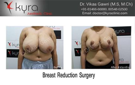 Breast Reduction Surgery