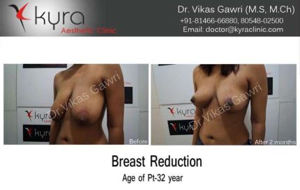 Breast Reduction