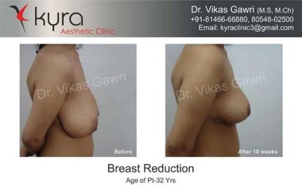 Breast Reduction