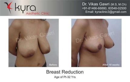 Breast Reduction