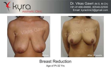 Breast Reduction