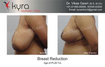 Breast Reduction