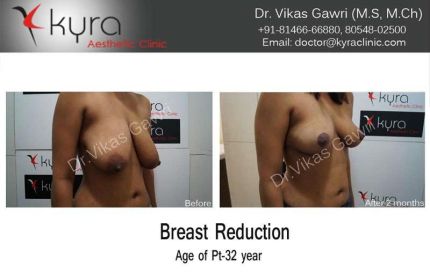 Breast-Reduction