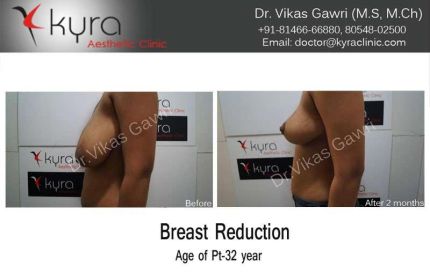 Breast Reduction